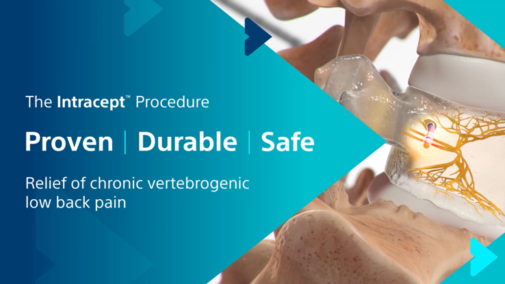 Basivertibral Nerve Ablation - Intracept Thumbnail