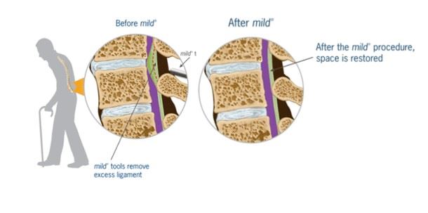 Mild for Lumbar Spinal Stenosis