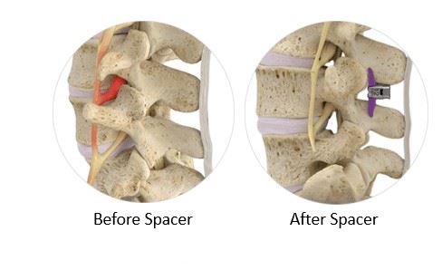 Before & After Spacer